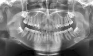 wisdom teeth x ray